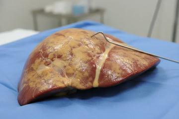 Fatty Liver Disease
