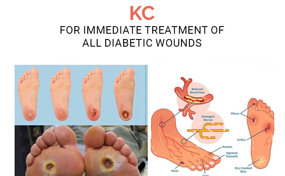 KC - For immediate treatment of all diabetic wounds (شوگر کے تمام زخموں کے فوری علاج کیلئے)